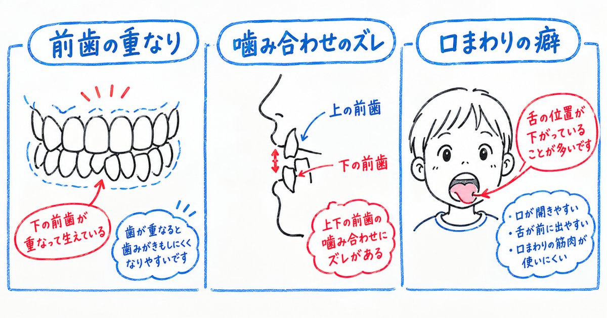 6歳の歯並びで相談を検討したい3つの受診目安