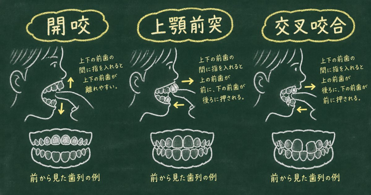 指しゃぶりが歯並びに影響するしくみ